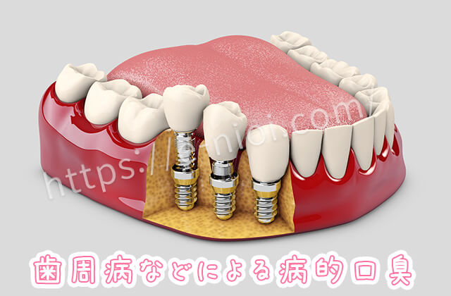 歯周病で浮いてしまっている歯と削れた歯茎の模型